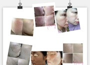 敏感皮肤烂脸修复方法_心酸烂脸史，秋冬季怎么拯救敏感肌？ 换皮级修护攻略