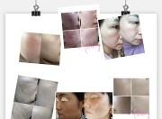 敏感皮肤烂脸修复方法_心酸烂脸史，秋冬季怎么拯救敏感肌？ 换皮级修护攻略